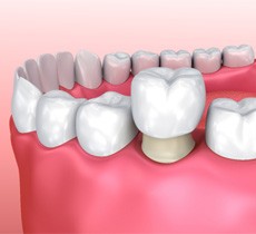 model of a dental crown