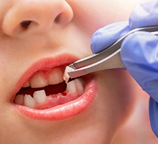 Young patient having a tooth removed