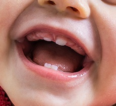baby teeth erupting