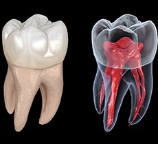 Illustration of tooth, showing pulp, nerves and root canal