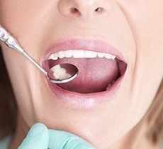 Closeup of healthy smile during dental exam