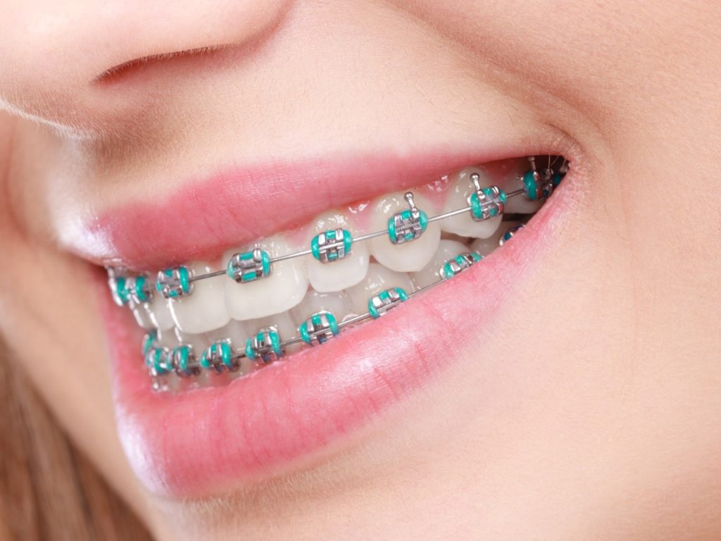 closeup of smile with braces