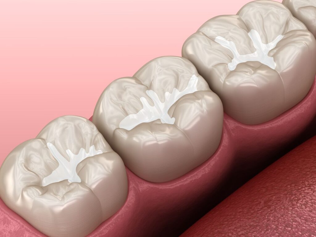 A CGI of teeth with dental sealants